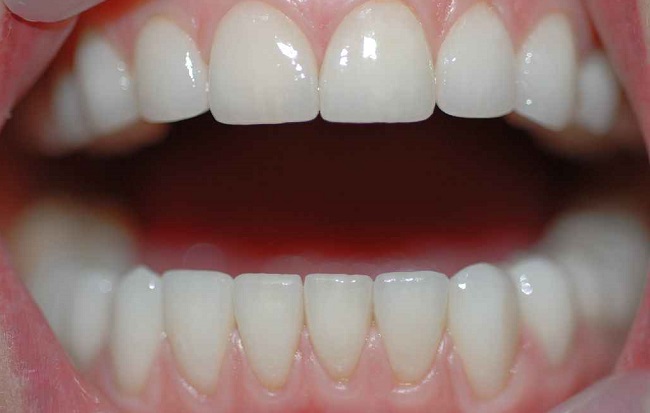 Зубы металлокерамика цвета фото