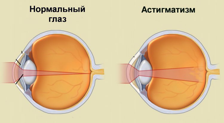 Как видят астигматики мир фото