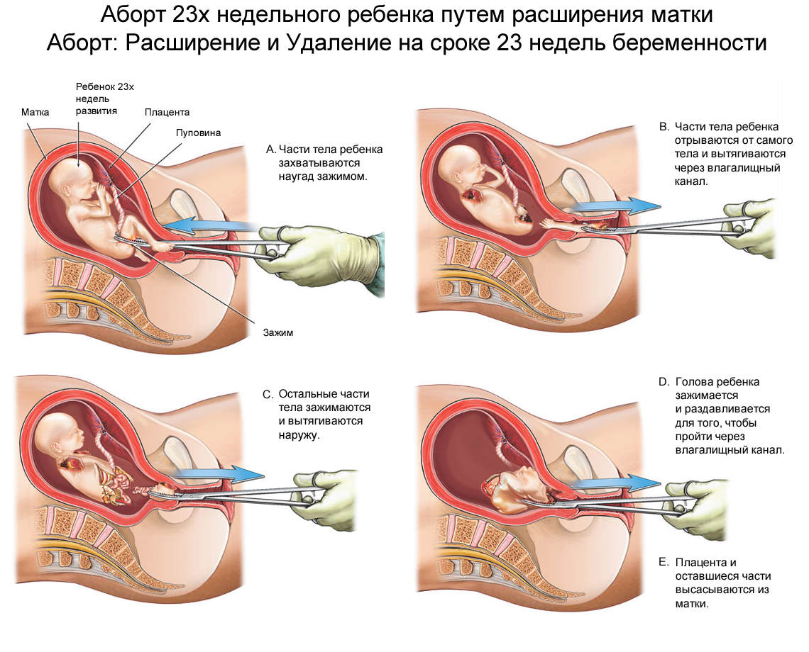 при замершей беременности продолжает болеть грудь фото 4