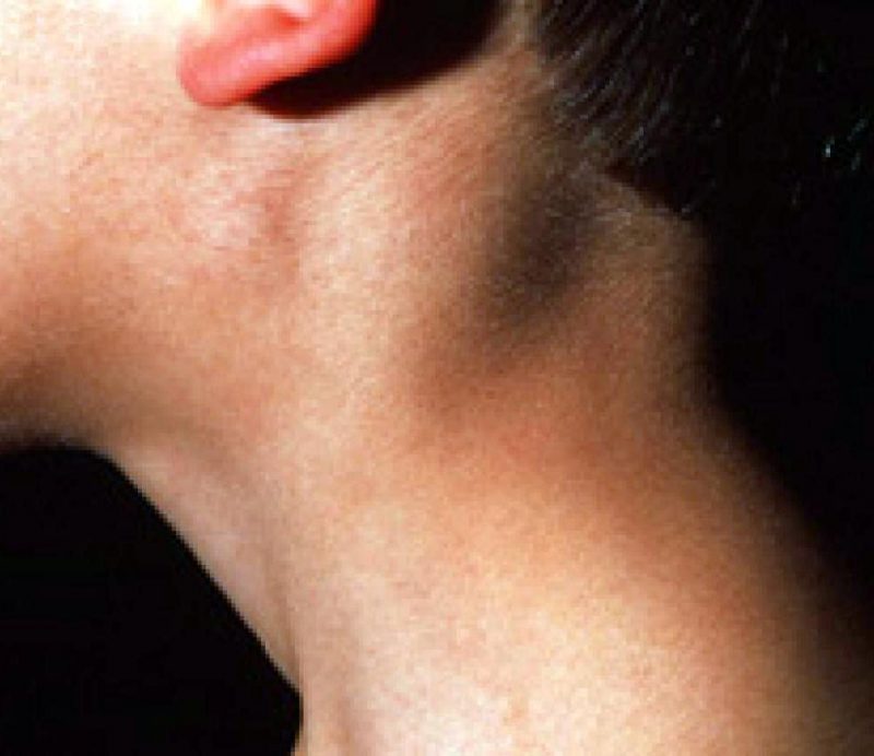 Что такое мононуклеоз у детей, как передается мононуклеоз, лечение