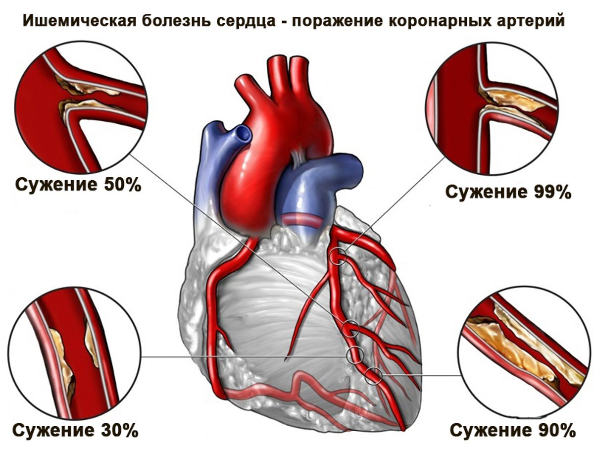 Фистула коронарной артерии