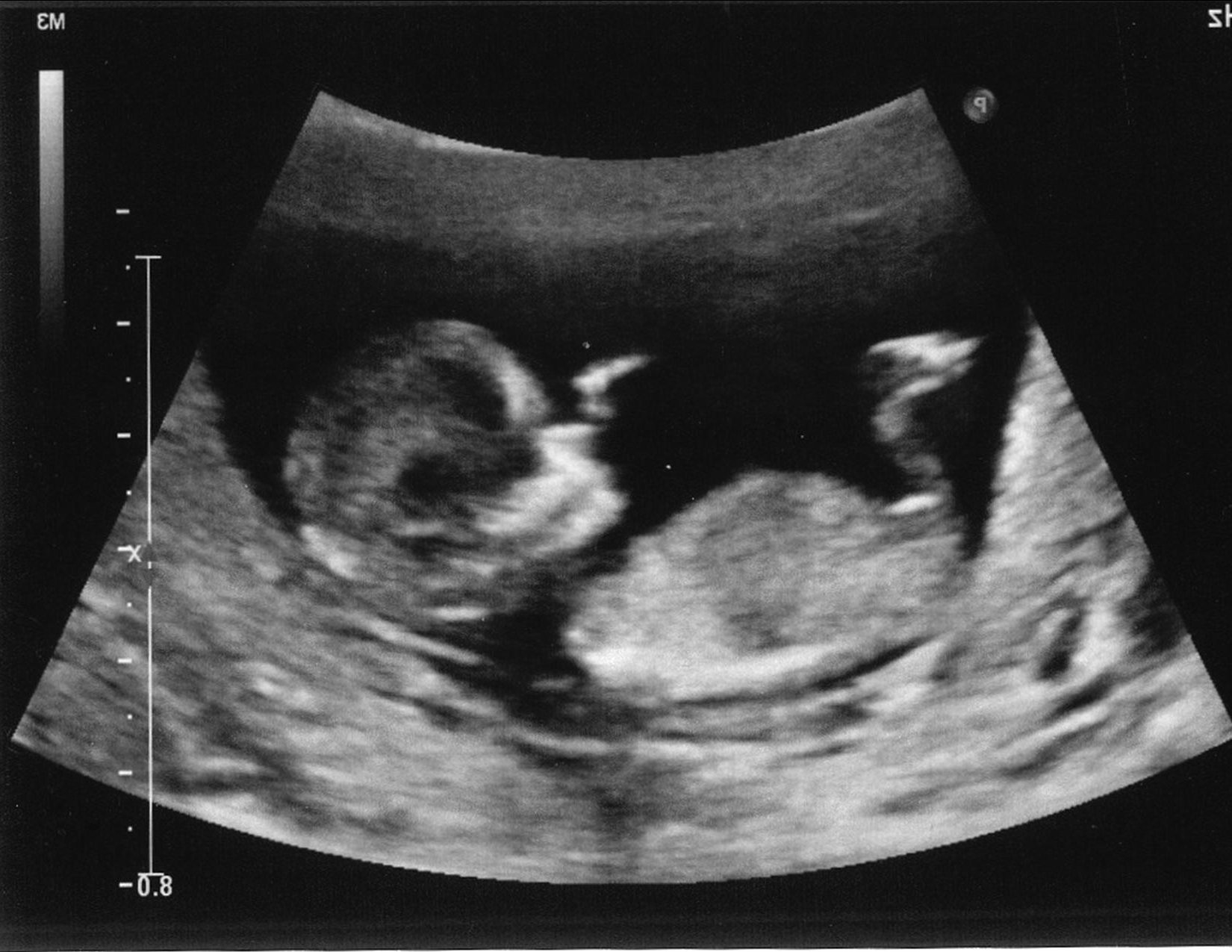 Беременность 12 3. Беременность 25 недель фото плода на УЗИ. УЗИ 1 скрининг 12 недель. Скрининг 13 недель беременности фото плода на УЗИ. УЗИ плода 12,5 недель беременности.