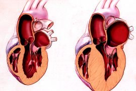 Гипертрофия левого желудочка сердца что это и как можно лечить?