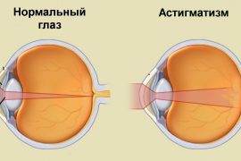 Астигматизм что это и как его лечить