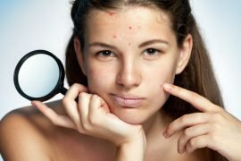 Как избавиться от прыщей на лице подростку