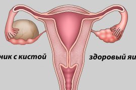 Что такое киста: причины, диагностика и лечение