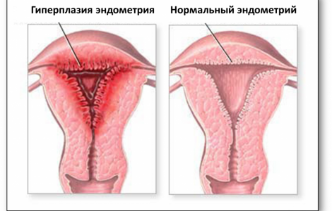 Что такое гиперплазия эндометрия?